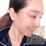 太美了太美了——超雅不开刀隆鼻手术178 太美了太美了——超雅不开刀隆鼻手术178