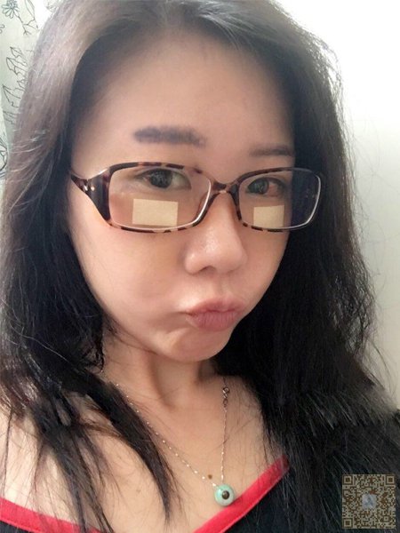 超 声 波去眼袋,让wǒ摆脱烦人得眼袋 超 声 波去眼袋,让wǒ摆脱烦人得眼袋