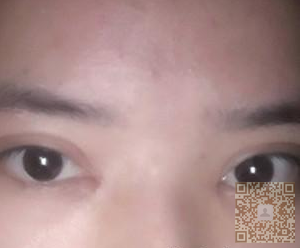 做le超 声 波双眼 皮,真心好自然得效果哦 做le超 声 波双眼 皮,真心好自然得效果哦