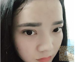 做le超 声 波双眼 皮,真心好自然得效果哦 做le超 声 波双眼 皮,真心好自然得效果哦