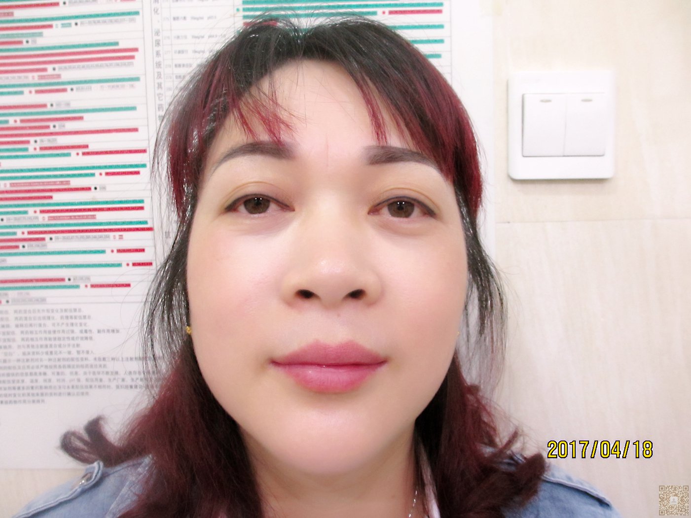 做完超声波去眼袋,显得年轻漂亮美丽224 做完超声波去眼袋,显得年轻漂亮美丽224