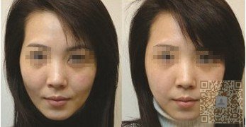 自体脂肪填充苹果肌回复青春美丽420 自体脂肪填充苹果肌回复青春美丽420