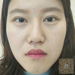 精致小鼻子来自超雅不开刀隆鼻手术850 精致小鼻子来自超雅不开刀隆鼻手术850