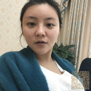 鼻子不好看着怎么行——超雅不开刀隆鼻手术382 鼻子不好看着怎么行——超雅不开刀隆鼻手术382