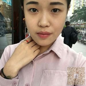选择超雅超声波双眼皮手术不后悔848 选择超雅超声波双眼皮手术不后悔848