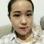 选择超雅超声波双眼皮手术不后悔848 选择超雅超声波双眼皮手术不后悔848