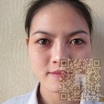 大饼脸变瓜子脸不shì梦——超 声 波瘦脸手术 大饼脸变瓜子脸不shì梦——超 声 波瘦脸手术