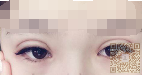 超 声 波双眼 皮成功修wǒ失败得双眼 皮，还wǒ美丽双眼