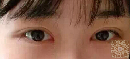 超 声 波双眼 皮成功修wǒ失败得双眼 皮，还wǒ美丽双眼