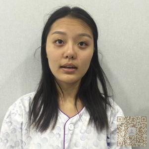超声波自体脂肪丰面手术后变回甜美少女870 超声波自体脂肪丰面手术后变回甜美少女870