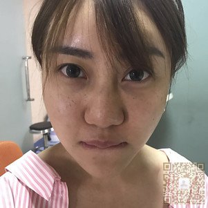 鼻子好看很重要——超雅不开刀隆鼻904 鼻子好看很重要——超雅不开刀隆鼻904
