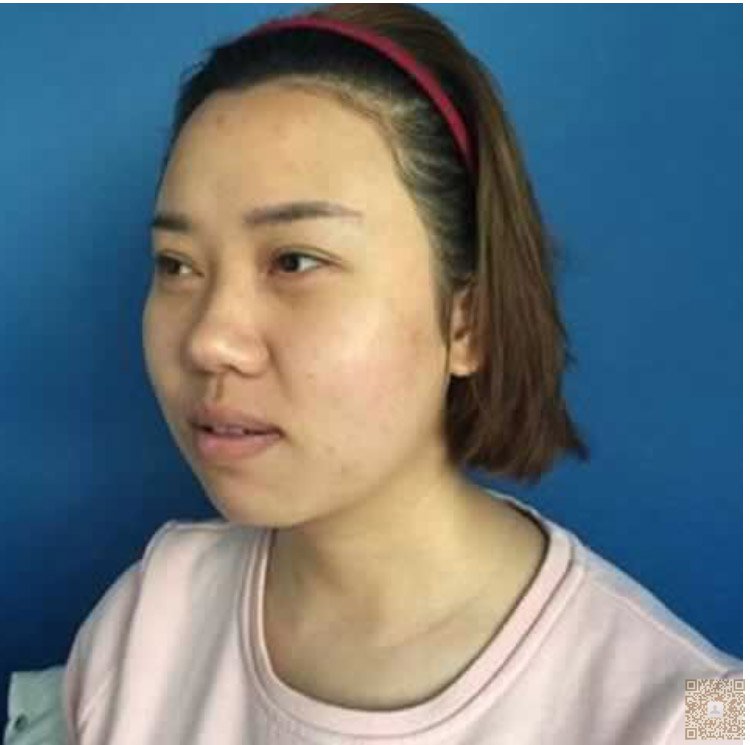 超声波去双下巴效果好,见效快778 超声波去双下巴效果好,见效快778