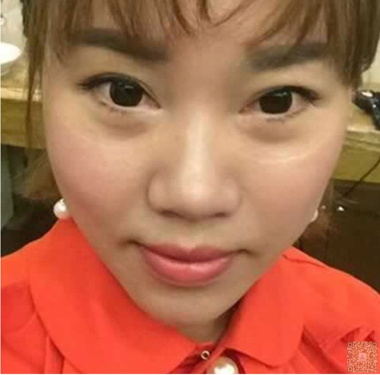 超声波去双下巴效果好,见效快778 超声波去双下巴效果好,见效快778