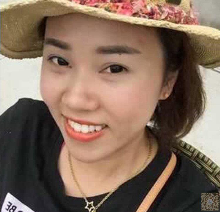 超声波去双下巴效果好,见效快778 超声波去双下巴效果好,见效快778