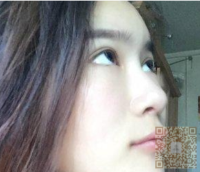 不开刀隆鼻后，瞬间觉得自己精神了很多560