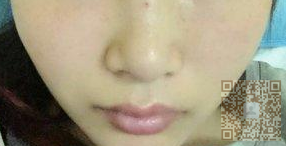 做le鼻综合手术,在超雅整形医院做得 做le鼻综合手术,在超雅整形医院做得