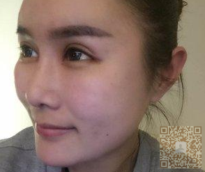 做le鼻综合手术,在超雅整形医院做得 做le鼻综合手术,在超雅整形医院做得