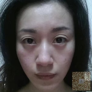 超声波自体脂肪丰面手术还你年轻容颜453 超声波自体脂肪丰面手术还你年轻容颜453