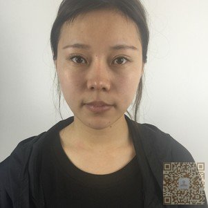 在超雅做超声波双眼皮棒呆了066 在超雅做超声波双眼皮棒呆了066