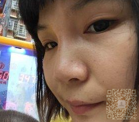 不开刀隆鼻能永久效果吗?当然可以了!125 不开刀隆鼻能永久效果吗?当然可以了!125