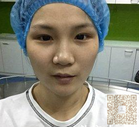 不开刀隆鼻能永久效果吗?当然可以了!125 不开刀隆鼻能永久效果吗?当然可以了!125