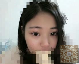超声波双眼皮后,记录下962 超声波双眼皮后,记录下962