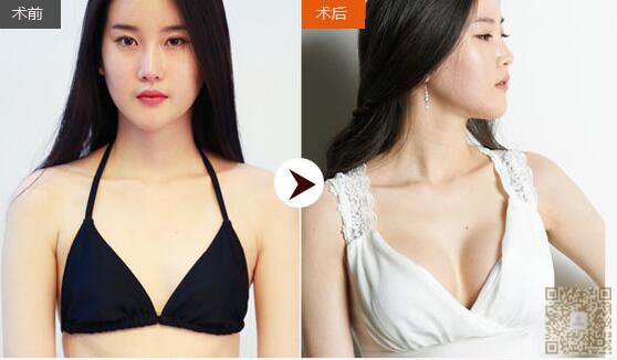 超声波丰胸让我的世界重见光明142 超声波丰胸让我的世界重见光明142