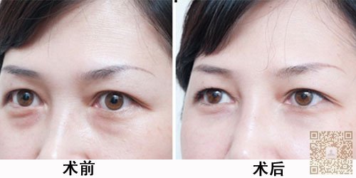 去眼袋一定要选择正规医院029 去眼袋一定要选择正规医院029