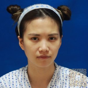我做的超声波自体脂肪丰面手术如此成功，原因在超雅349