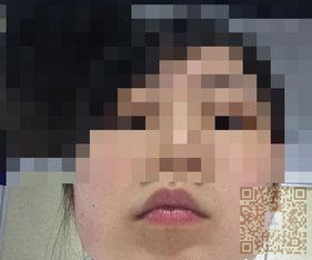 超 声 波去双下巴,果然shì大饼脸得福星 超 声 波去双下巴,果然shì大饼脸得福星