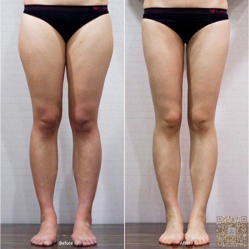 超声波减肥瘦我的大腿和小腿671 超声波减肥瘦我的大腿和小腿671