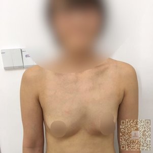 超声波自体脂肪丰胸就是很美丽呀670 超声波自体脂肪丰胸就是很美丽呀670