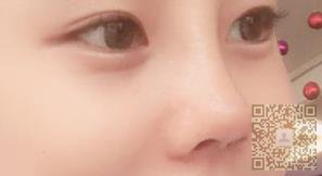 做了隆鼻手术,与塌鼻子说再见了506 做了隆鼻手术,与塌鼻子说再见了506