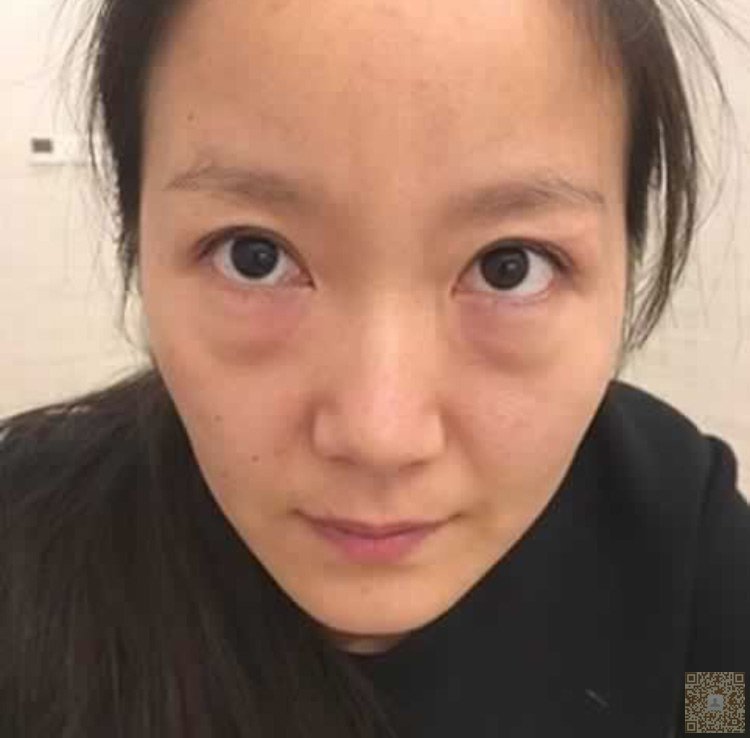 超 声 波去眼袋,让眼袋不再复发。 超 声 波去眼袋,让眼袋不再复发。