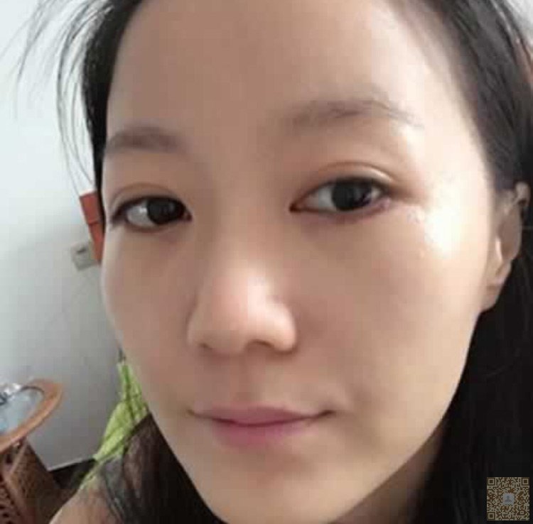 超 声 波去眼袋,让眼袋不再复发。 超 声 波去眼袋,让眼袋不再复发。