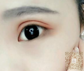 超声波双眼皮果然可以帮我形成双眼皮~~~780 超声波双眼皮果然可以帮我形成双眼皮~~~780