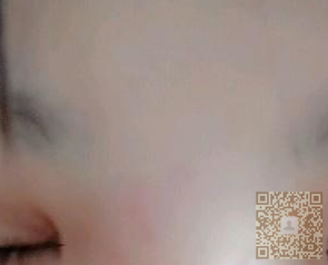超声波双眼皮果然可以帮我形成双眼皮~~~780 超声波双眼皮果然可以帮我形成双眼皮~~~780