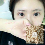 超声波美容日记,我做了超声波双眼皮601 超声波美容日记,我做了超声波双眼皮601