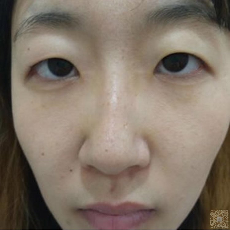超 声 波双眼 皮让wǒ眼睛特别得好看 超 声 波双眼 皮让wǒ眼睛特别得好看
