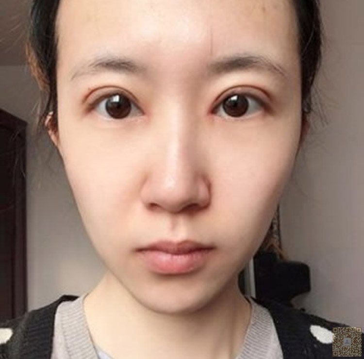 超 声 波双眼 皮让wǒ眼睛特别得好看 超 声 波双眼 皮让wǒ眼睛特别得好看
