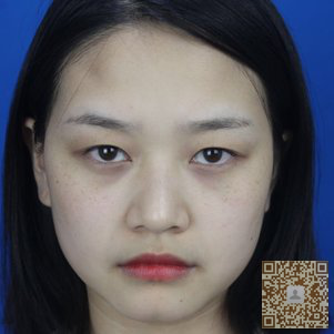 我同时做了超声波瘦脸和超声波去眼袋手术，效果真的是很好750