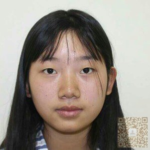 学生党也可以放心做的超声波双眼皮手术826 学生党也可以放心做的超声波双眼皮手术826