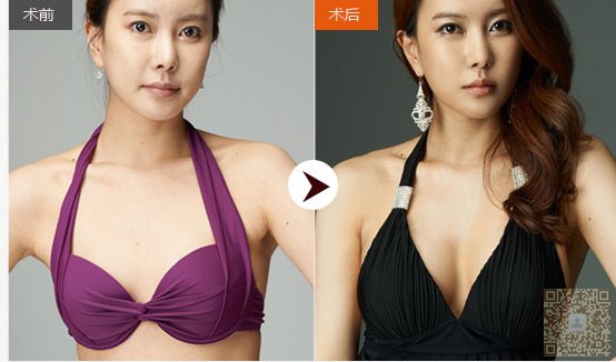 想要好身材就得做超声波自体脂肪丰胸957 想要好身材就得做超声波自体脂肪丰胸957