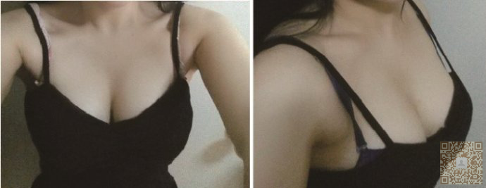 好朋友给wǒ介绍le超 声 波自体脂肪丰胸，让wǒ得生活变得更加得美好