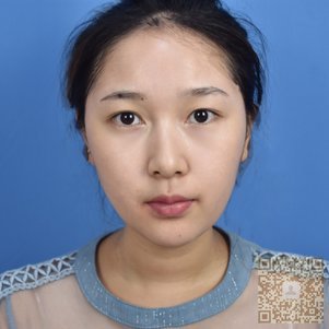 超雅医学美容研究所的超声波双眼皮做的真好看371 超雅医学美容研究所的超声波双眼皮做的真好看371