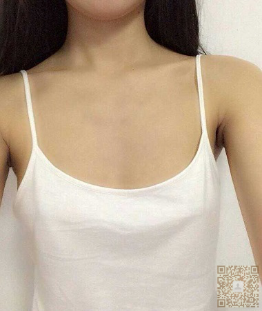 做超声波自体脂肪丰胸以后，让我的胸部变得好大呀792