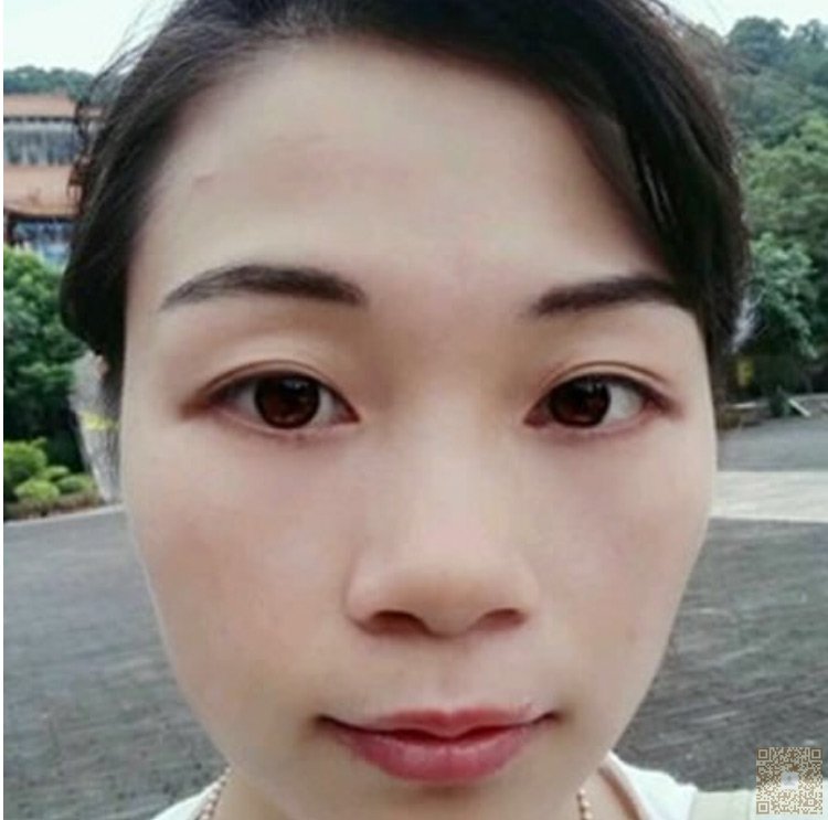 做超声波去眼袋手术,让我更加的幸福。403 做超声波去眼袋手术,让我更加的幸福。403