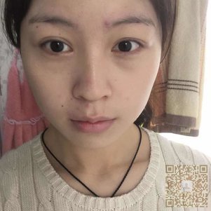 超 声 波自体脂肪丰面手术让wǒ永远十八岁 超 声 波自体脂肪丰面手术让wǒ永远十八岁