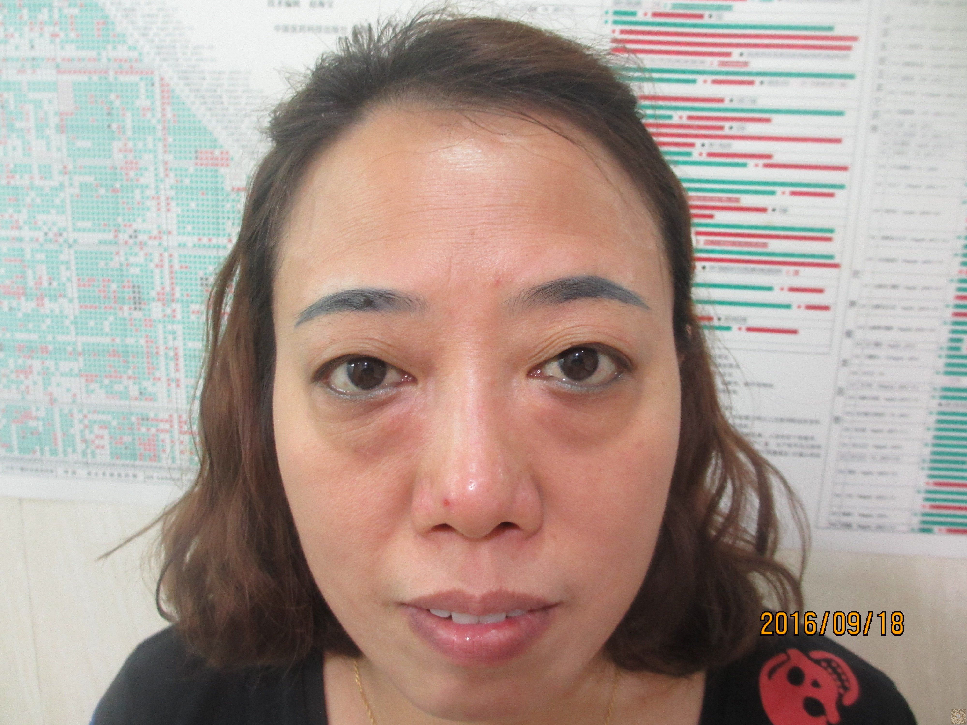 来到超雅医学美容研究所做了超声波去眼袋的手术684