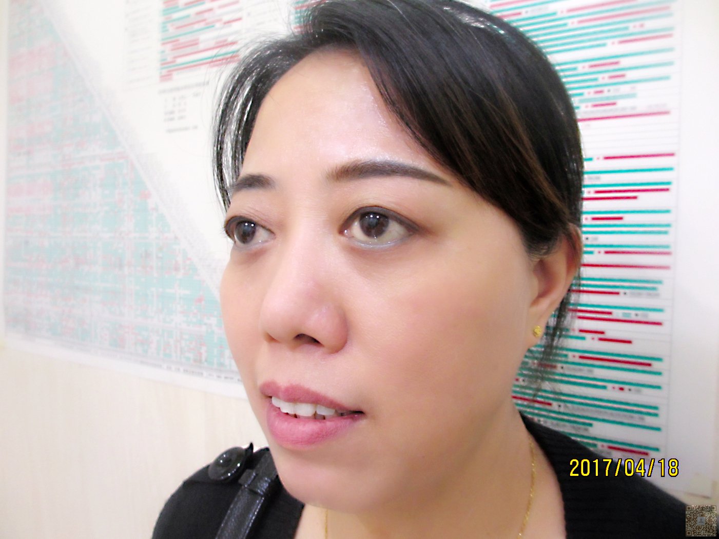 来到超雅医学美容研究所做了超声波去眼袋的手术684